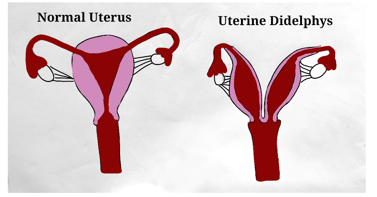 A woman with two uterus